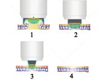 Depilação a laser diodo 808nm